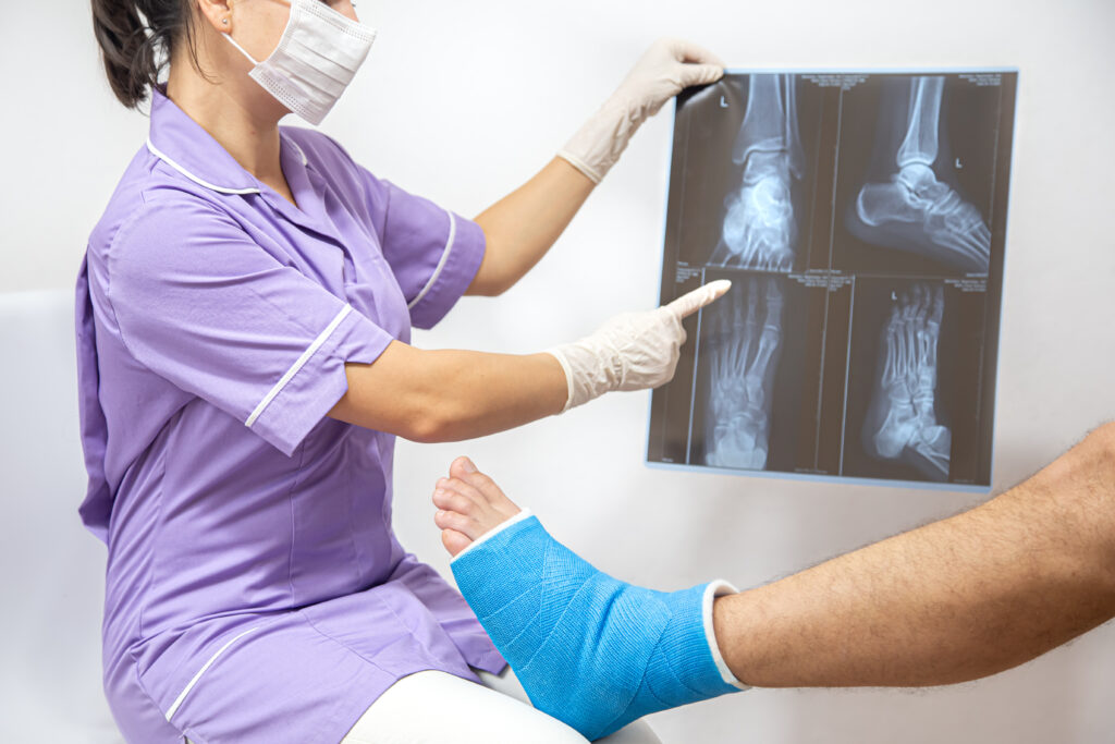 bone fractures